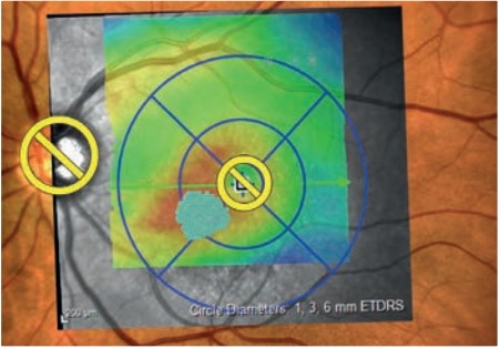 El láser amarillo 557 nanómetros se abre paso como técnica para tratar las patologías de la retina